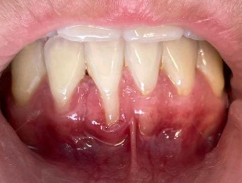 Curso de cirurgia mucogengival e peri-implantar